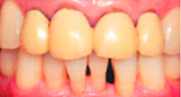 ttl-implant-img09.jpg