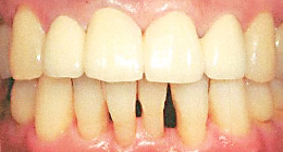 ttl-implant-img10.jpg