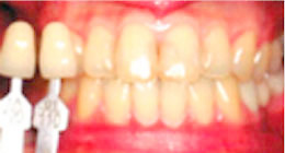 ttl-implant-img09.jpg