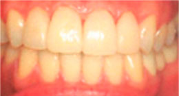 ttl-implant-img10.jpg