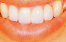 ttl-implant-img09.jpg