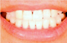 ttl-implant-img10.jpg