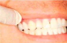 ttl-implant-img10.jpg