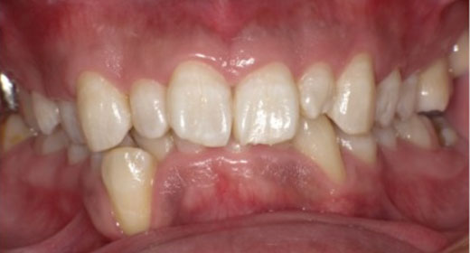 ttl-implant-img10.jpg